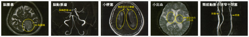 発見できる病気