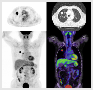 PET/CT検査とがんの検出