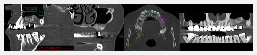 歯科インプラントCT